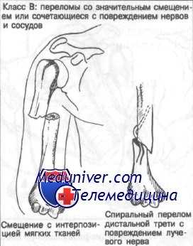 перелом диафиза плечевой кости