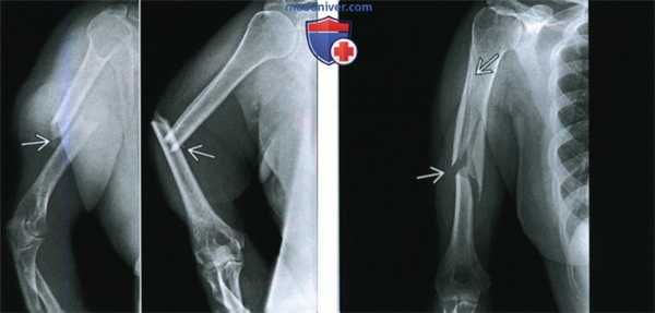 Признаки перелома диафиза плечевой кости