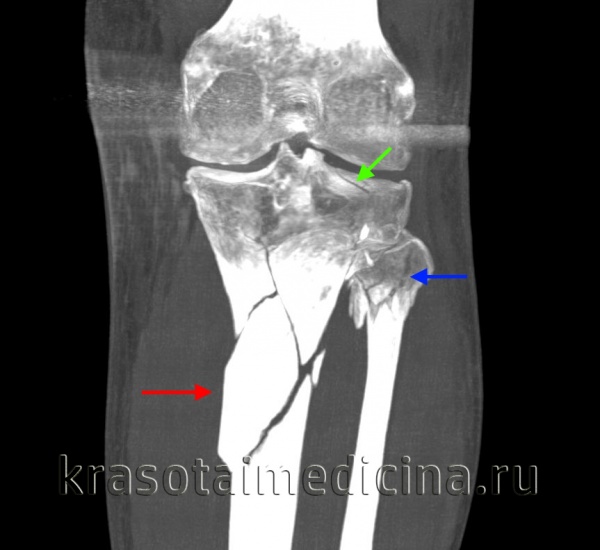 КТ коленного сустава и голени. Оскольчатый перелом большеберцовой кости в верхней трети диафиза (красная стрелка), перелом головки малоберцовой кости (синяя стрелка), перелом латерального мыщелка большеберцовой кости (зеленая стрелка).