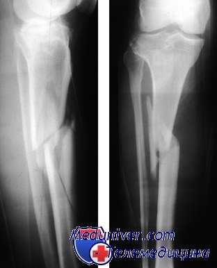 перелом костей голени