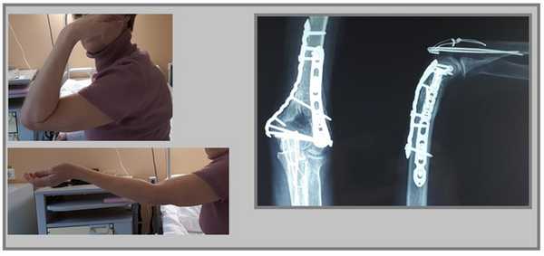 мыщелки плеча результат операции