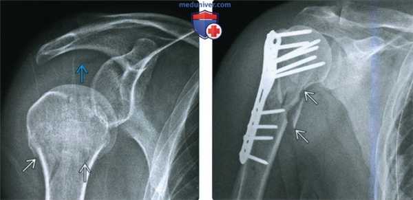 Рентгенограмма, КТ, МРТ при переломе головки и шейки плечевой кости