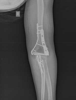 после операции при переломе мыщелков плеча рентген
