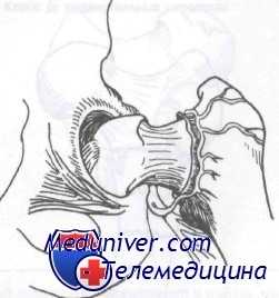 перелом головки бедренной кости