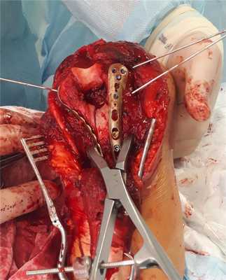 остеосинтез перелома мыщелков плеча премоделированными пластинами