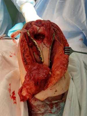 операция при переломе мыщелков плеча