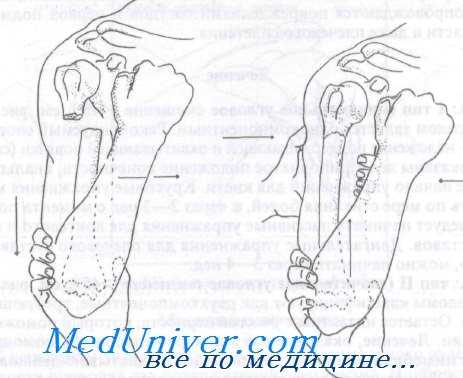 перелом хирургической шейки плечевой кости