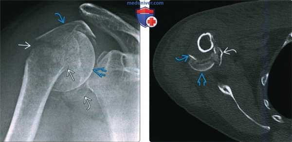 Рентгенограмма, КТ, МРТ при переломе головки и шейки плечевой кости