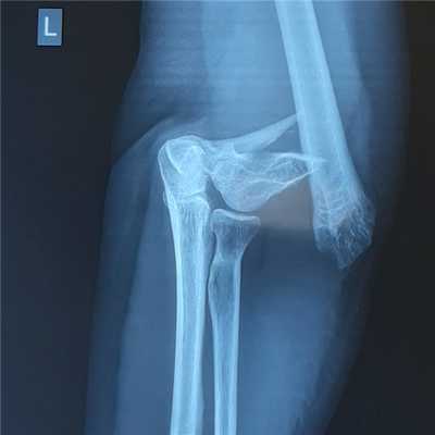 перелом мыщелков плеча