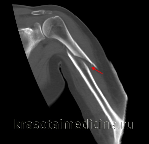 Перелом большого бугорка плечевой кости