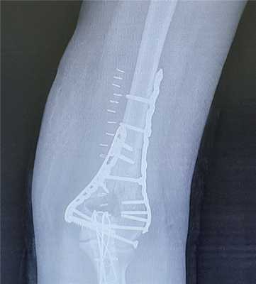 остеосинтез перелома мыщелков плеча 2 пластинами