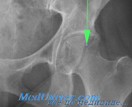 перелом головки бедренной кости