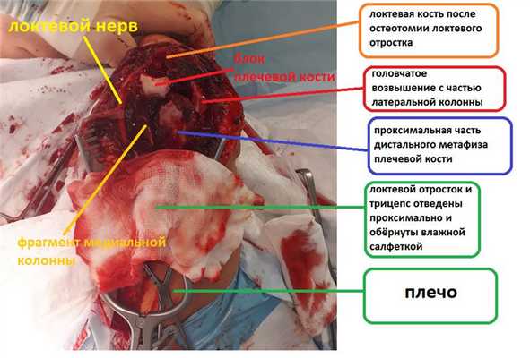 перелом мыщелков плеча операция