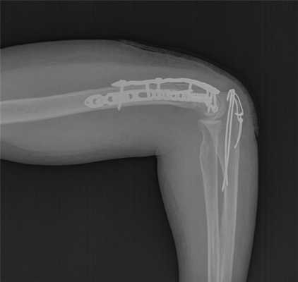 после операции остеосинтеза мыщелков плечевой кости рентген