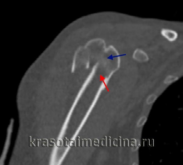 КТ плечевого сустава. Оскольчатый перелом хирургической шейки плечевой кости со смещением отломков. Дистальный отломок (красная стрелка) вколочен в проксимальный отломок (синяя стрелка).