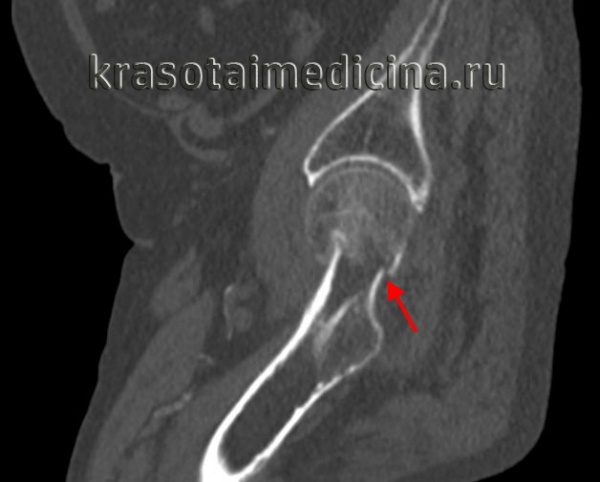 Переломы бедренной кости у детей
