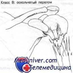 перелом хирургической шейки плечевой кости