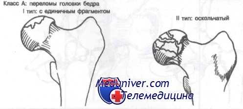 перелом головки бедренной кости
