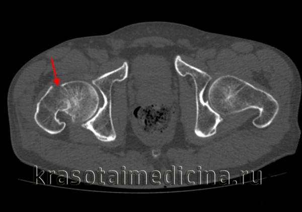 КТ таза. Перелом шейки правой бедренной кости со смещением отломков.