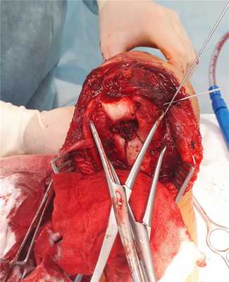 остеосинтез перелома мыщелков плеча прелиминарная фиксация