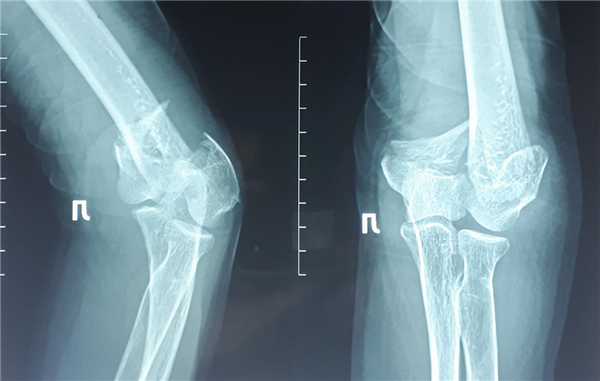 перелом мыщелков плечевой кости рентген
