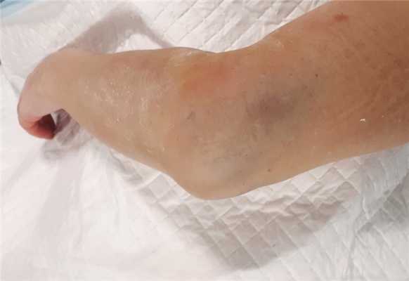 перелом локтевого сустава