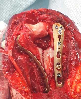 хирургическое лечение перелома мыщелков плеча