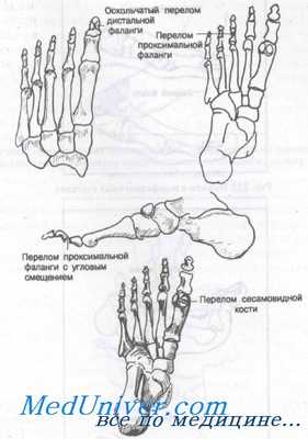 переломы и вывихи пальцев стопы
