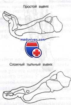 переломы и вывихи пальцев стопы