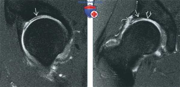 Признаки хрящевых и костно-хрящевых повреждений тазобедренного сустава на артрограмме