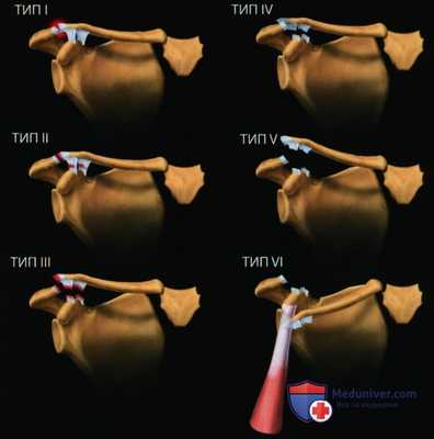Признаки травмы акромиально-ключичного сустава