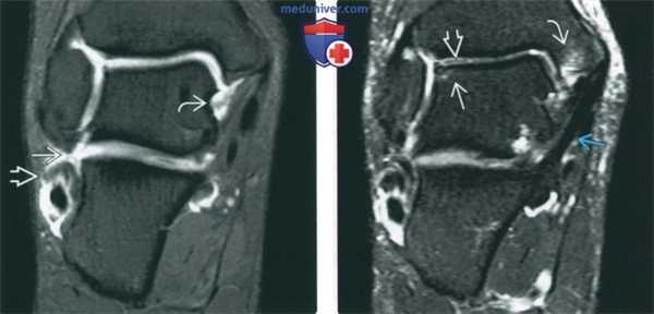Советы по оценке МРТ артрограммы голеностопного сустава
