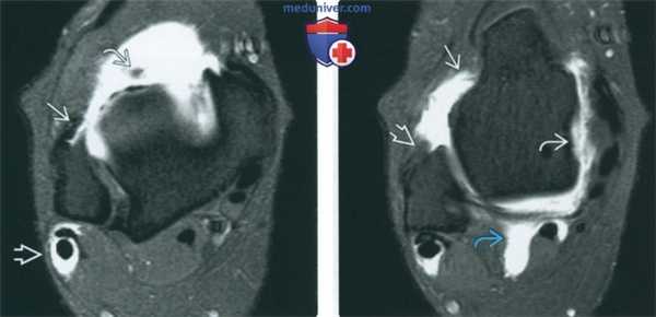 Советы по оценке МРТ артрограммы голеностопного сустава