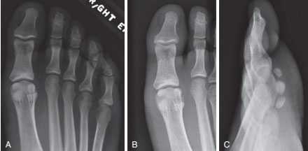 Расхождение сесамовидных костей