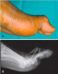 Контрактура суставов и тыльный подвывих большого пальца