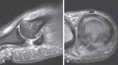 МРТ повреждения связок первого пальца