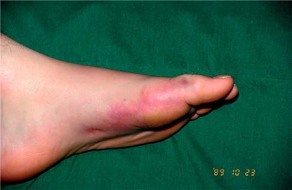 Повреждение первого пальца