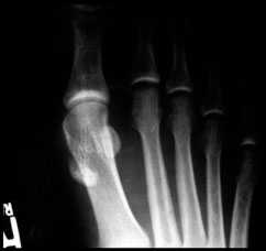 Рентгенограмма стопы в прямой проекции