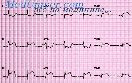 инфаркт миокарда