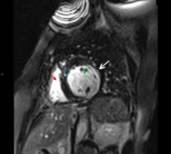 МРТ сердца. Правый желудочек (красная стрелка), левый желудочек (зеленая стрелка), межжелудочковая перегородка (синяя стрелка). Позднее контрастное усиление субэндокардиальной зоны левого желудочка, характерное для инфаркта миокарда (белая стрелка).