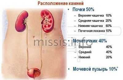 Как располагаются камни в почках