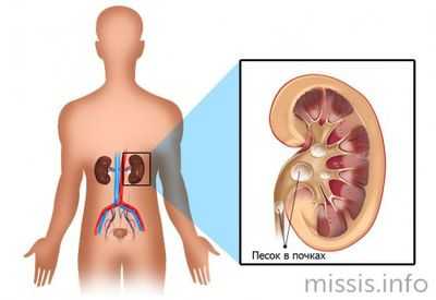 Песок в почках