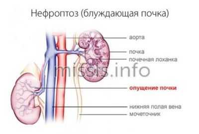 Как отличить нефроптоз