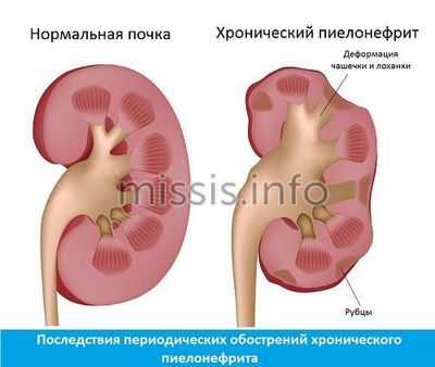 Что такое пиелонефрит