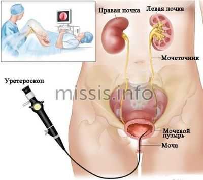 Как проводится урография почек