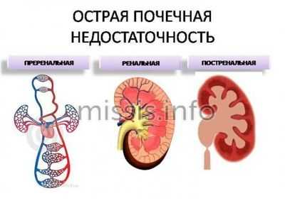 Разновидности почечной недостаточности