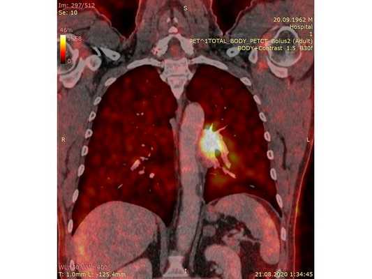 ПЭТ-КТ (наложение, корональный срез)