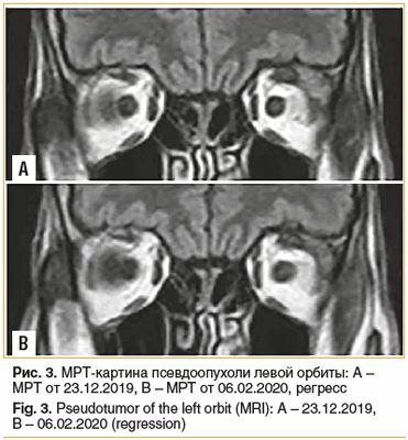 Рис. 3. МРТ-картина псевдоопухоли левой орбиты: А - МРТ от 23.12.2019, В - МРТ от 06.02.2020, регресс Fig. 3. Pseudotumor of the left orbit (MRI): А - 23.12.2019, В - 06.02.2020 (regression)