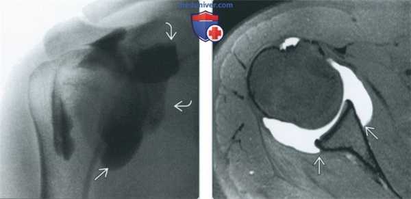 Признаки растяжения капсулы и адгезивного капсулита плечевого сустава на артрограмме