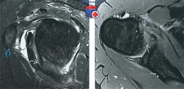 Признаки растяжения капсулы и адгезивного капсулита плечевого сустава на артрограмме